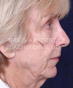 Before - Notice the volume loss of the mid-face occurring with facial aging, red arrow