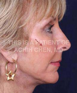 After - Notice how restoring volume creates a "lift" by restoring the mid-face volume of a youthful face, red arrow