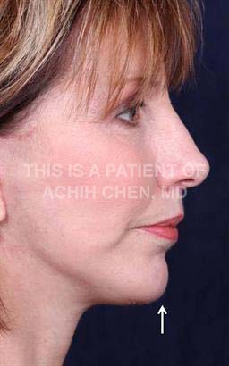 After
Notice how the chin implant helps make her neck look longer and jawline more defined, white arrows