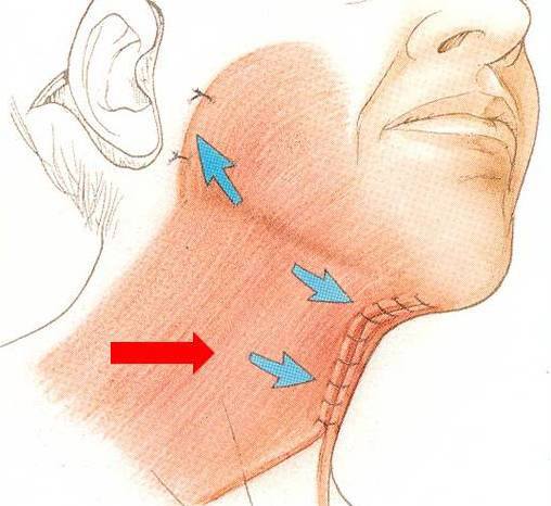 Neck lift graphic