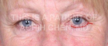 Incision for Transcutaneous Lower Eyelid Surgery