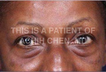 Lower Eyelid Bag/Bulge Image