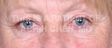 Lower Eyelid Bag/Bulge with Excess Skin Image