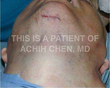 Neck lift incision under chin