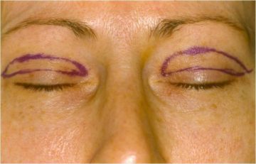 Upper eyelid surgery (blepharoplasty) incisions