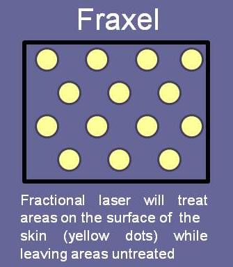 Diagram of Fraxel Laser Skin Treatment