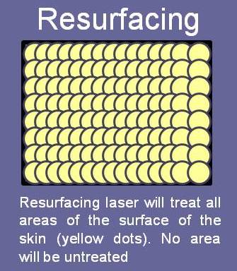 Diagram of laser skin resurfacing versus fraxel