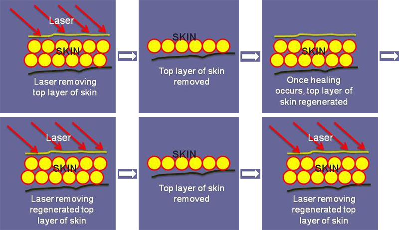 Laser Resurfacing Diagram