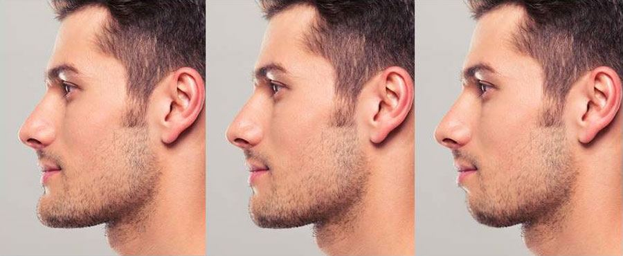 cheekbone implants men before and after