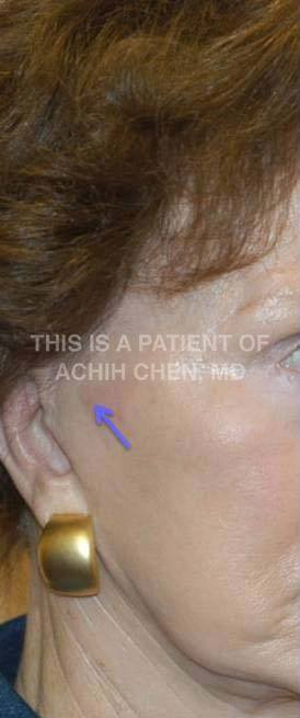 Facelift, Revision Facelift – Charleston Facial Plastic Surgery - SC