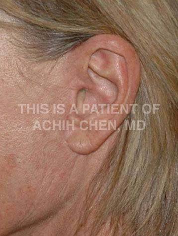 Facelift, Revision Facelift – Charleston Facial Plastic Surgery - SC