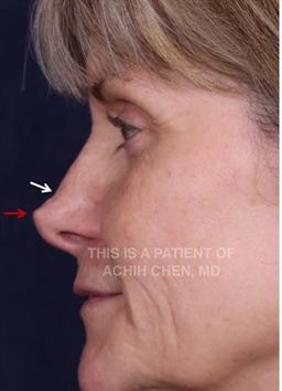 Before: This is a before profile photo with the red arrow pointing to a tip graft that was placed during the patient's first surgery that is off center, making the nose look crooked. The white arrow is pointing to an indentation that is in the area above the tip that also really bothers the patient.